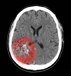 Brain Injuries